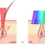 laser vs ipl